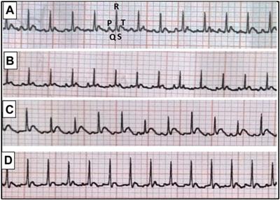 <mark class="highlighted">Escitalopram</mark> Ameliorates Cardiomyopathy in Type 2 Diabetic Rats via Modulation of Receptor for Advanced Glycation End Products and Its Downstream Signaling Cascades